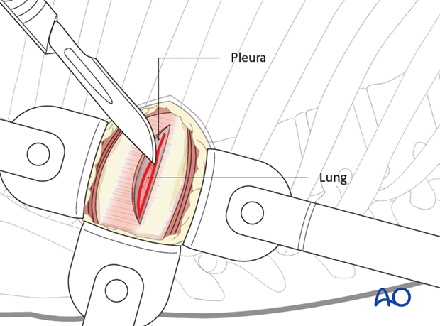 Thoracic and lumbar fractures: Minimally invasive right sided thoracic approach (T4-T10)