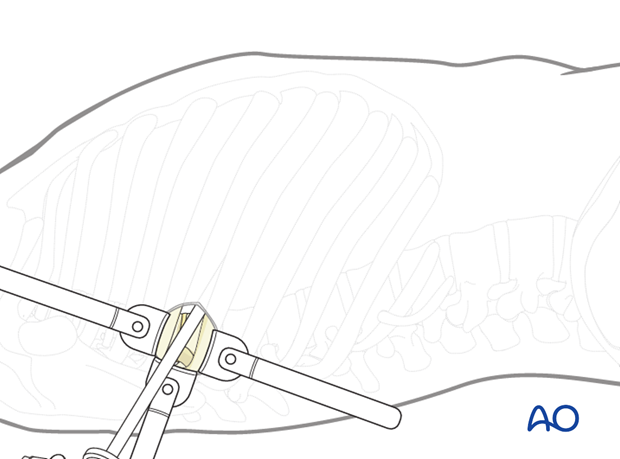 Thoracic and lumbar fractures: Minimally invasive right sided thoracic approach (T4-T10)