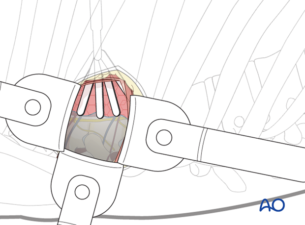 Thoracic and lumbar fractures: Minimally invasive right sided thoracic approach (T4-T10)