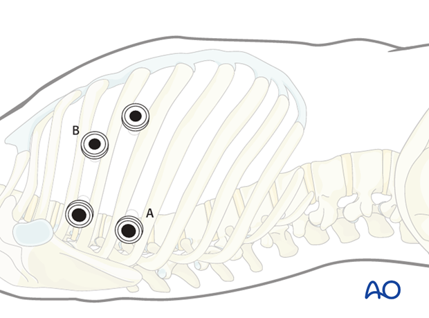 Thoracic and lumbar fractures: Minimally invasive right sided thoracic approach (T4-T10)