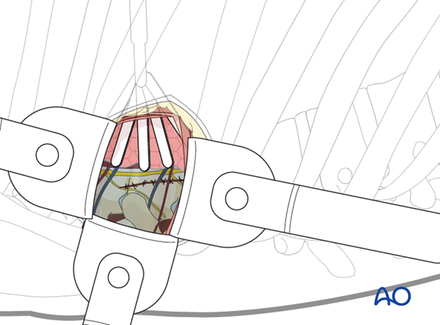 Thoracic and lumbar fractures: Minimally invasive right sided thoracic approach (T4-T10)