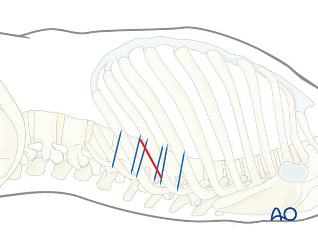 Thoracic and lumbar fractures: Minimally invasive left sided thoracic approach (T10-L2)