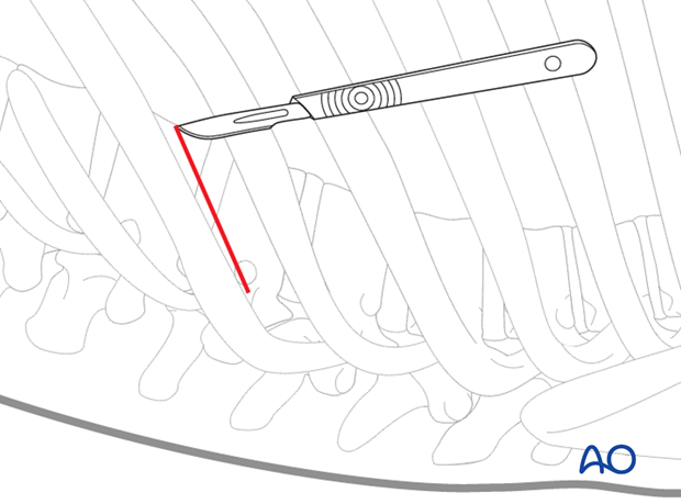 Minimally invasive left sided thoracic approach (T10-L2)