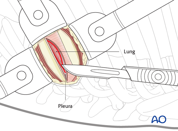 Thoracic and lumbar fractures: Minimally invasive left sided thoracic approach (T10-L2)