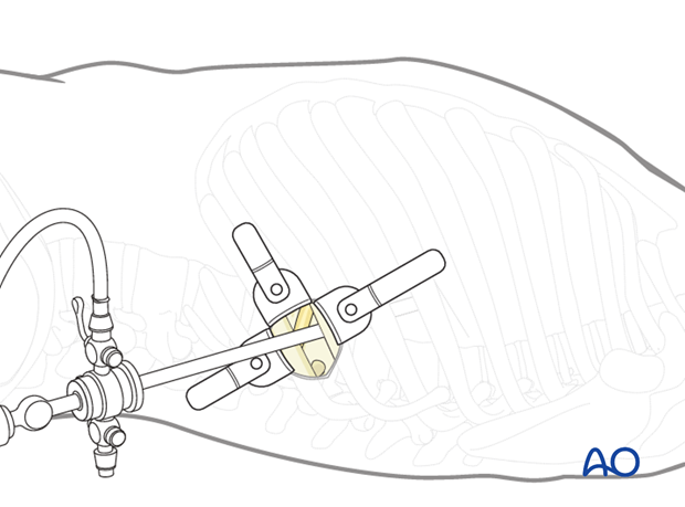 Thoracic and lumbar fractures: Minimally invasive left sided thoracic approach (T10-L2)