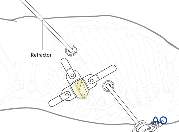 Thoracic and lumbar fractures: Minimally invasive left sided thoracic approach (T10-L2)