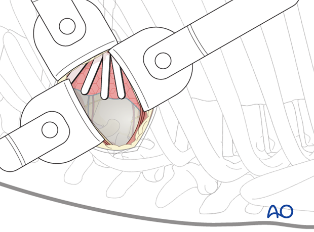 Thoracic and lumbar fractures: Minimally invasive left sided thoracic approach (T10-L2)