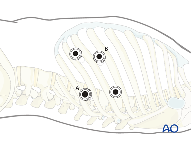 Thoracic and lumbar fractures: Minimally invasive left sided thoracic approach (T10-L2)