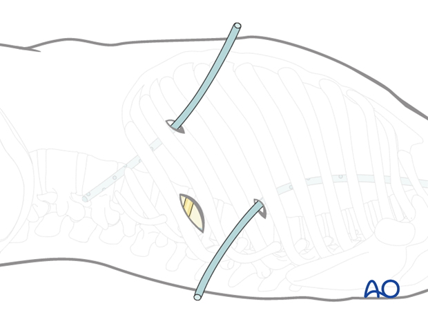 Thoracic and lumbar fractures: Minimally invasive left sided thoracic approach (T10-L2)