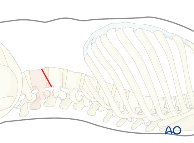 Minimally invasive lumbotomy (L2-L4)