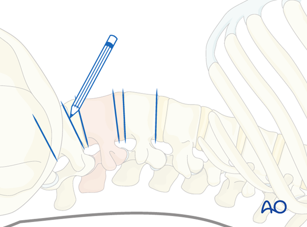 Thoracic and lumbar fractures: Minimally invasive lumbotomy (L2-L4)