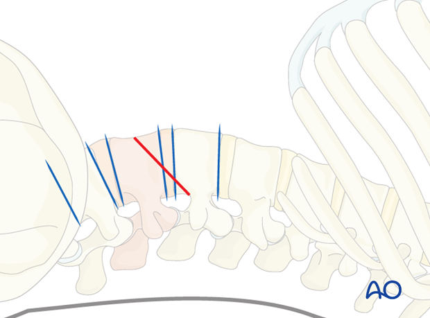 Thoracic and lumbar fractures: Minimally invasive lumbotomy (L2-L4)