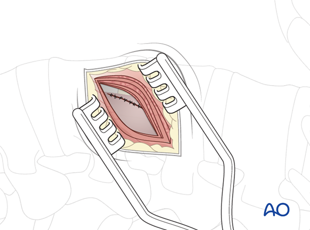 Thoracic and lumbar fractures: Minimally invasive lumbotomy (L2-L4)