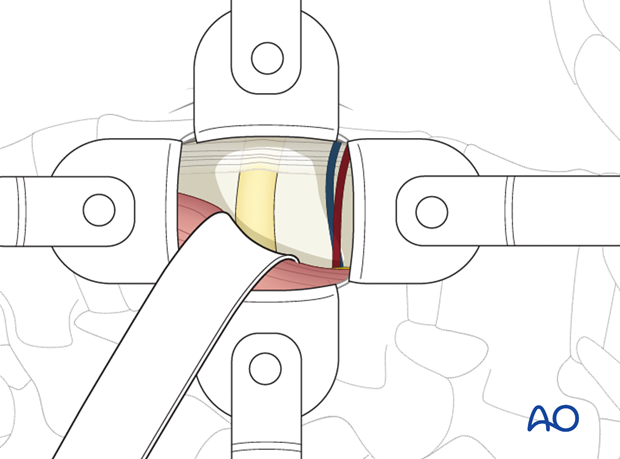 Thoracic and lumbar fractures: Minimally invasive lumbotomy (L2-L4)