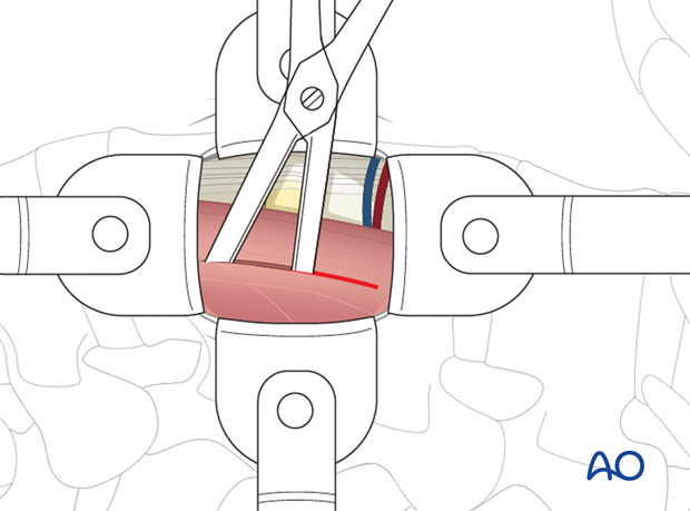 Thoracic and lumbar fractures: Minimally invasive lumbotomy (L2-L4)