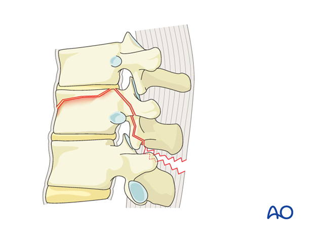 Thoracic and Lumbar Fractures: Rationale for fracture classification