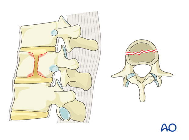 Thoracic and Lumbar Fractures: Rationale for fracture classification