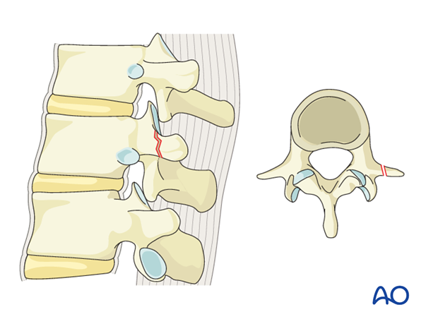 Thoracic and Lumbar Fractures: Rationale for fracture classification