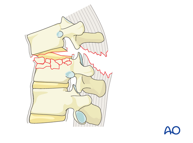 Thoracic and Lumbar Fractures: Rationale for fracture classification