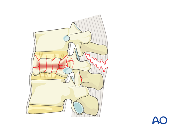 Thoracic and Lumbar Fractures: Rationale for fracture classification