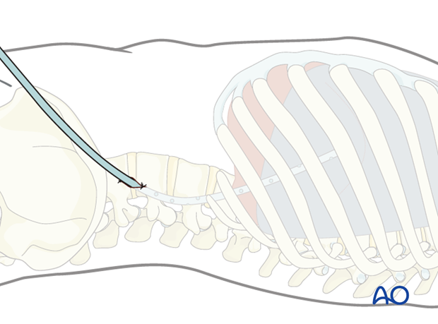 Thoracic and lumbar fractures: Patient examination - clinical evaluation