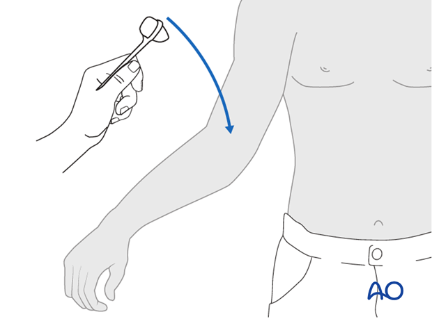 Thoracic and lumbar fractures: Patient examination - neurological evaluation