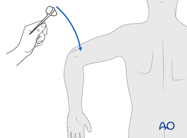 Thoracic and lumbar fractures: Patient examination - neurological evaluation