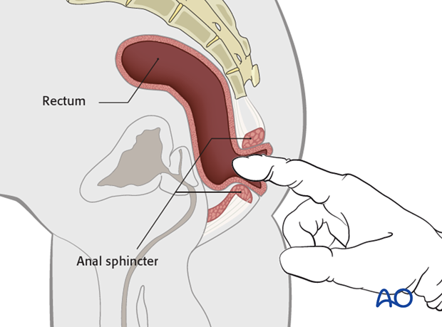 Thoracic and lumbar fractures: Patient examination - neurological evaluation