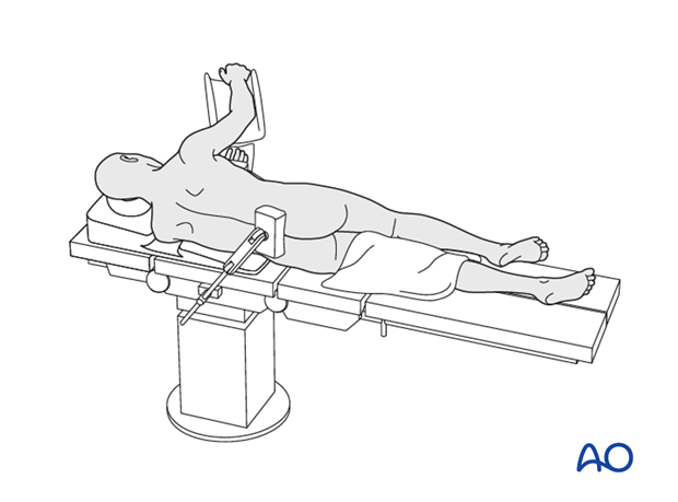 Thoracic and lumbar fractures: Minimally invasive right sided thoracic approach (T4-T10)