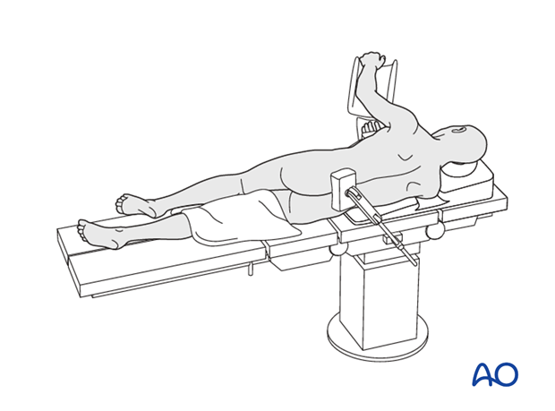 Thoracic and lumbar fractures: Left sided thoracotomy (T3-L1/2)