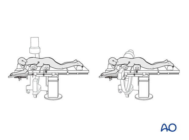 percutaneous pedicle screws