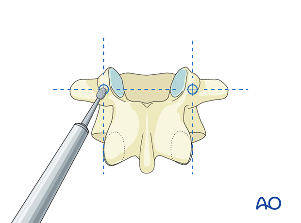 Opening the cortex during pedicle screw insertion in the thoracolumbar spine.