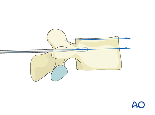 pedicle screw insertion