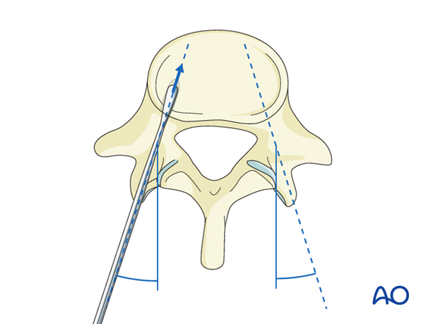 pedicle screw insertion