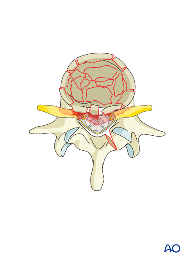 posterior decompression techniques