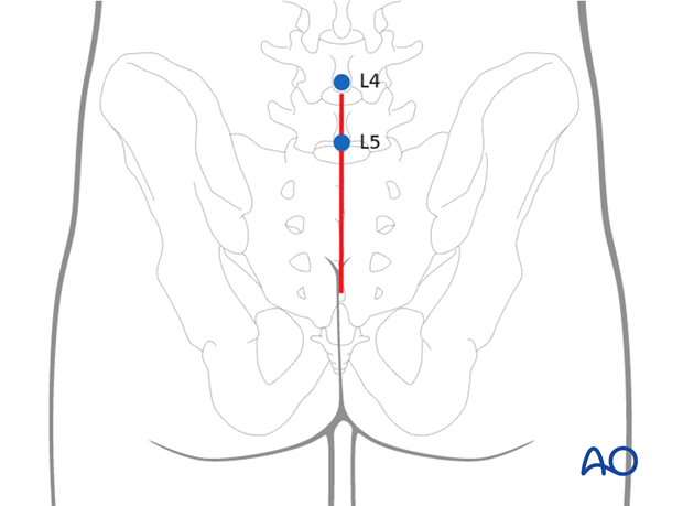 posterior midline approach to the sacrum