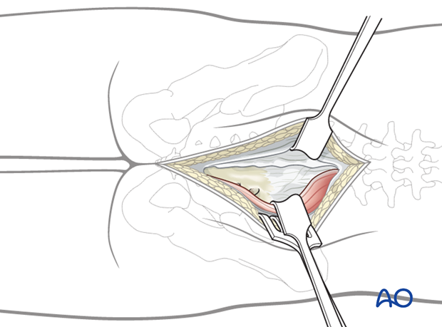 posterior midline approach to the sacrum