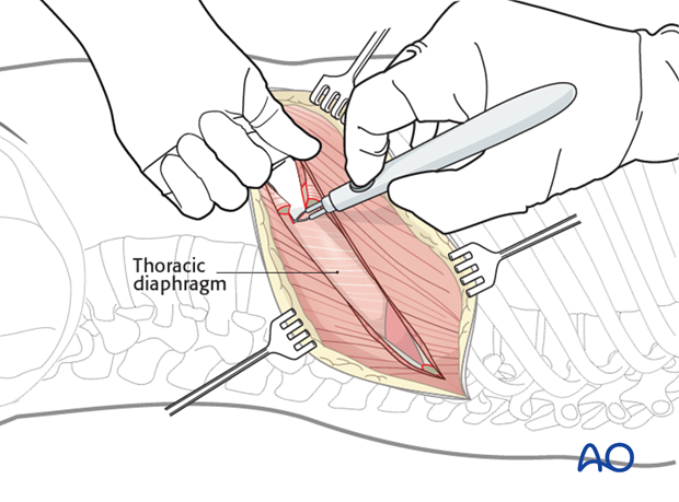 anterior approach to the lumbar spine