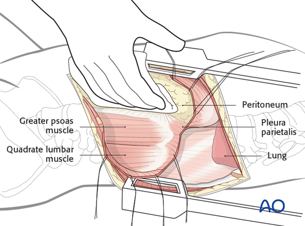 anterior approach to the lumbar spine