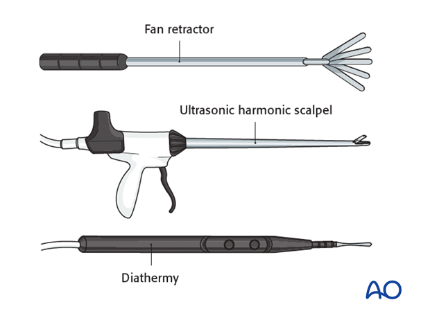 anterior thoracoscopic approach