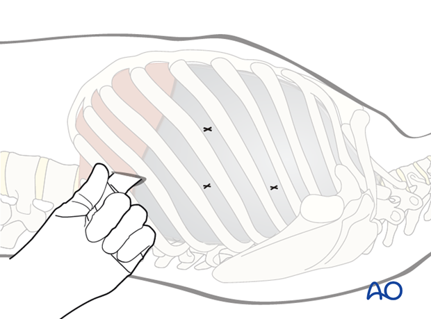 anterior thoracoscopic approach