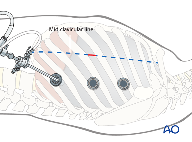 anterior thoracoscopic approach