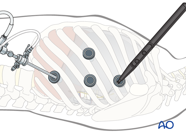 anterior thoracoscopic approach