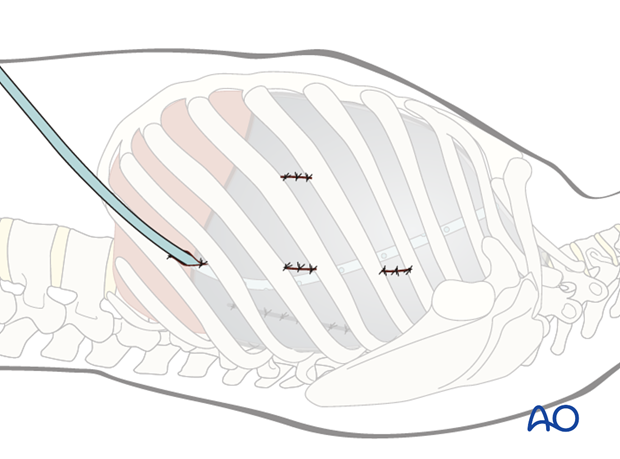 anterior thoracoscopic approach