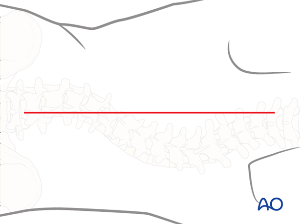 posterior approach