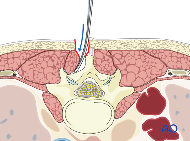 posterior approach