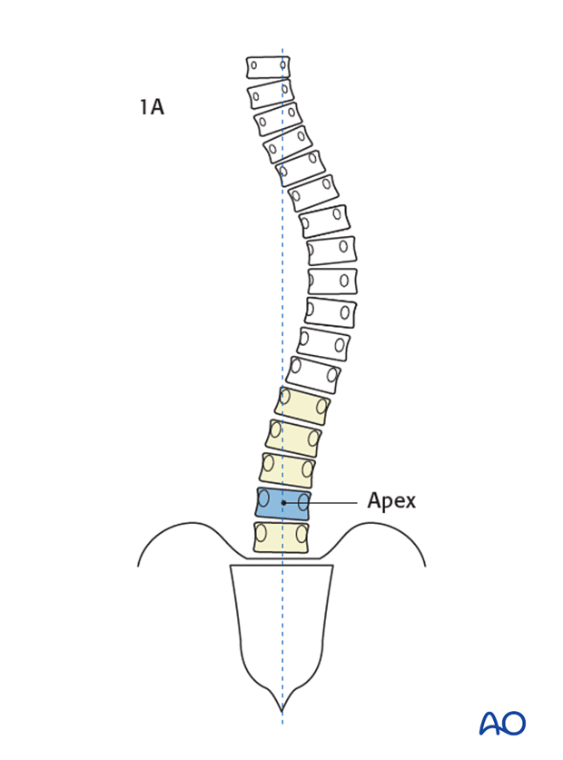 lenke classification