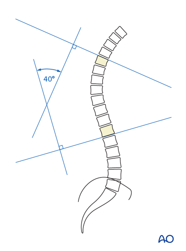 lenke classification