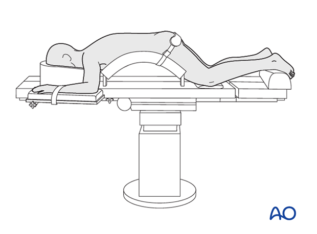 preparation posterior procedures