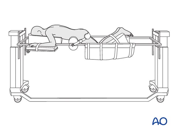 preparation posterior procedures